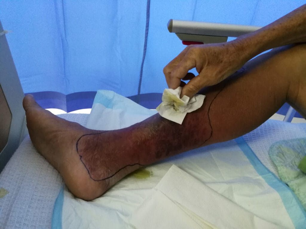 Close-up of a diabetes patient resting in bed with leg swelling and redness symptoms.