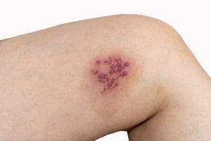 An image of shingles or herpes zoster a viral skin condition marked by a painful, red rash with clustered blisters.